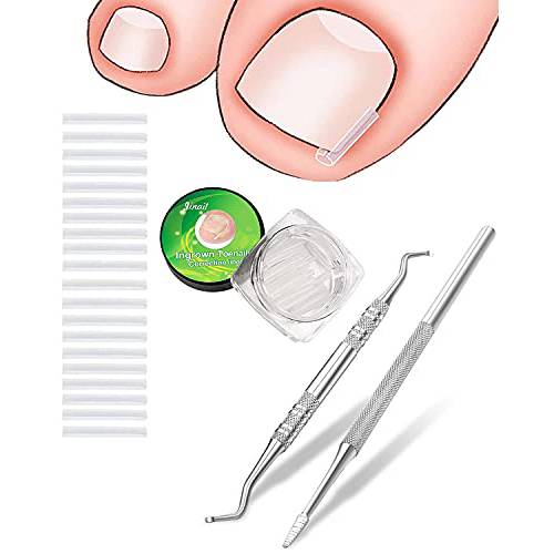 (50 +2) Pack Professional Ingrown Toenail Correction Treatment Kit, 50 Pcs Ingrown Toenail Corrector Straightener Strips Recover Clips with 2 Pcs Ingrown Toenail File And Lifter